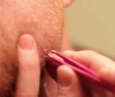 Ingrown Hair in Spanish